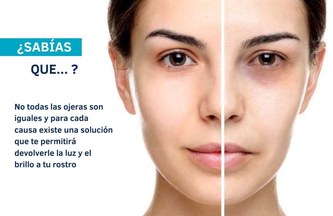 Cómo tratar las Ojeras Hundidas Clínica Be Dharma