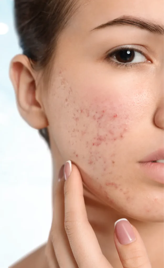 tratamiento para el acné en medellín