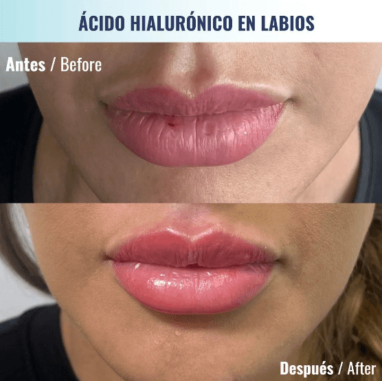 Aumento de labios con Acido hialuronico en clinica bedharma (1)