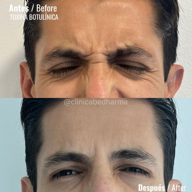 Botox antes y después