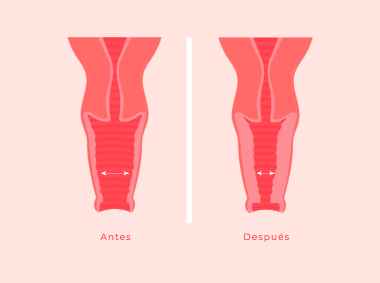 Rejuvenecimiento vulvar: Tratamiento efectivo y seguro con Forma V