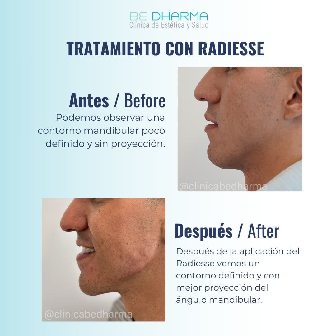 ANTES Y DESPUÉS DE BIOESTIMULADOR RADIESSE 3