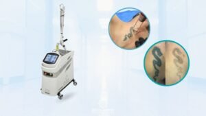 Borrar tatuajes en Medellín