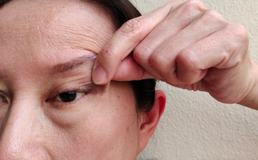Cómo quitar bolsas en los ojos por exceso de piel - Clínica Be Dharma