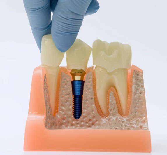 Coronas dentales en Medellín - Clínica Be Dharma - Be Dharma Dental