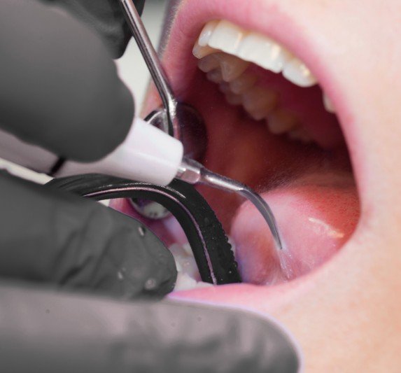 Detartraje dental en Medellín - Clínica Be Dharma - Be Dharma Dental