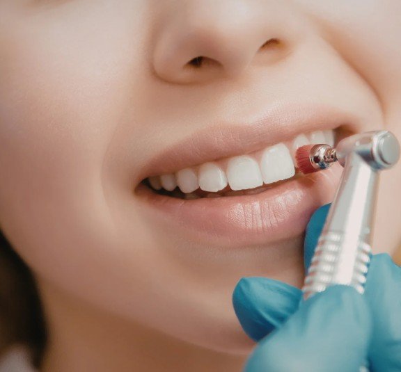 Profilaxis dental en Medellín - Clínica Be Dharma - Be Dharma Dental