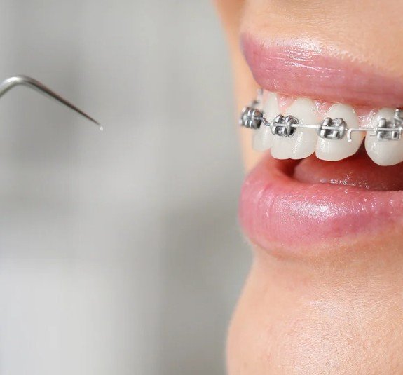 Retiro de ortodoncia en Medellín - Clínica Be Dharma - Be Dharma Dental