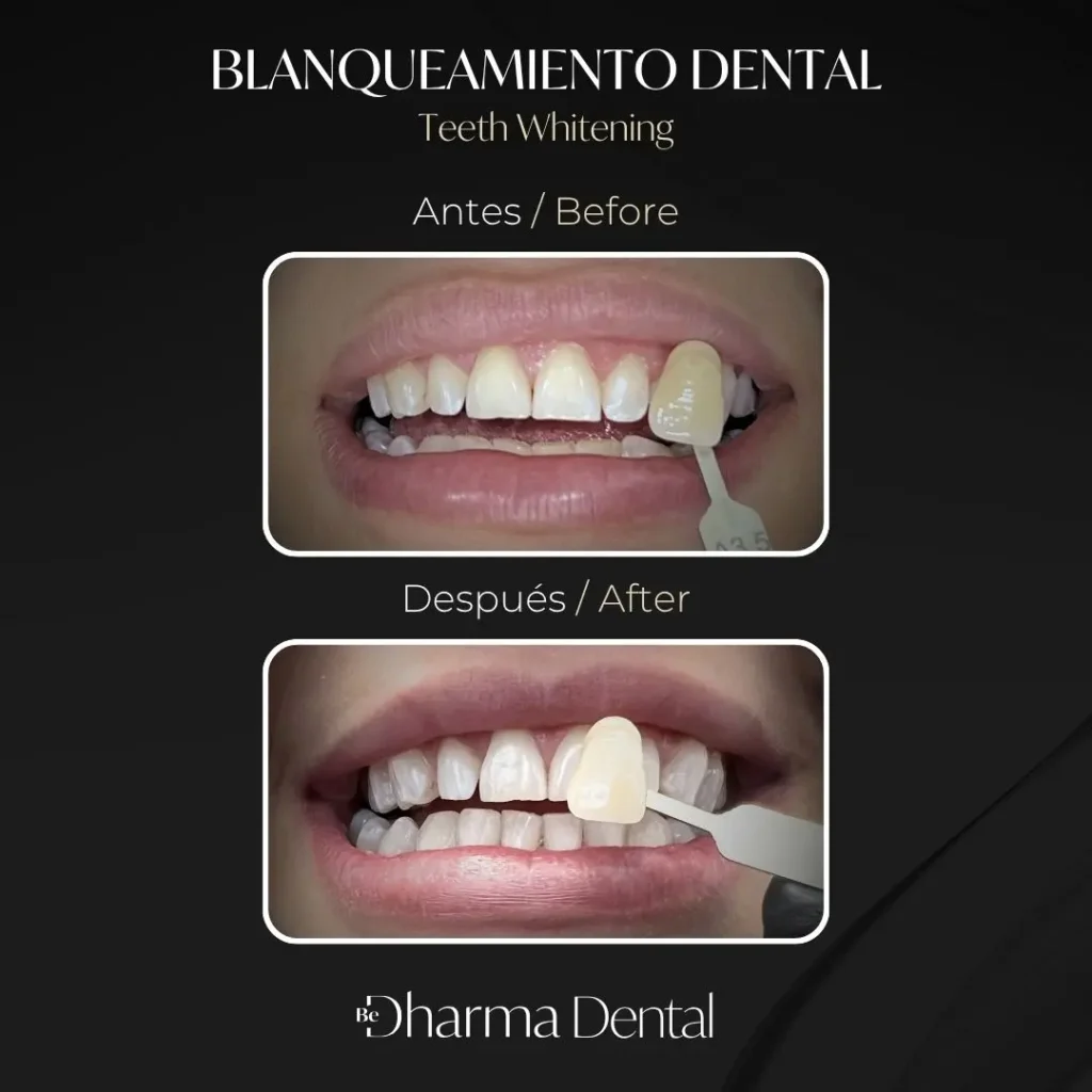 Blanqueamiento dental antes y después en la clínica odontológica Be Dharma Dental - Medellín, Colombia- 060426