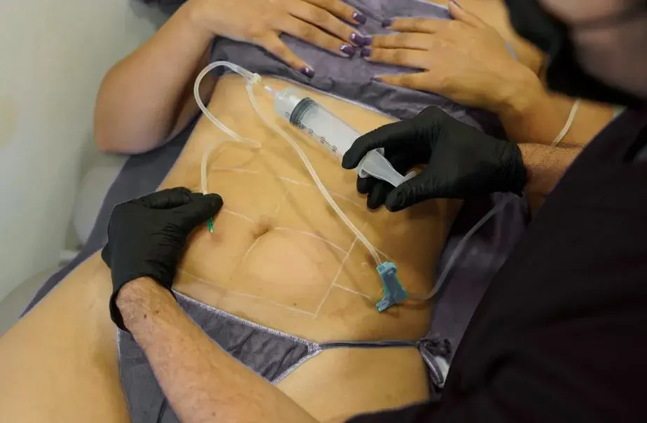 Grasa abdominal que no se va-Clínica Be Dharma