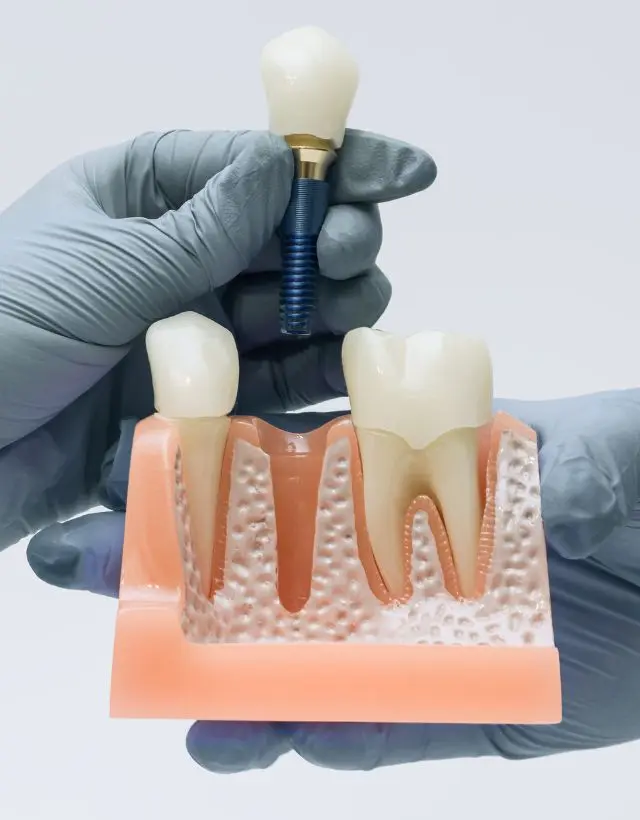 Implante dental en Medellín, Colombia, en la clínica odontológica Be Dharma Dental - Clínica estética Be Dharma