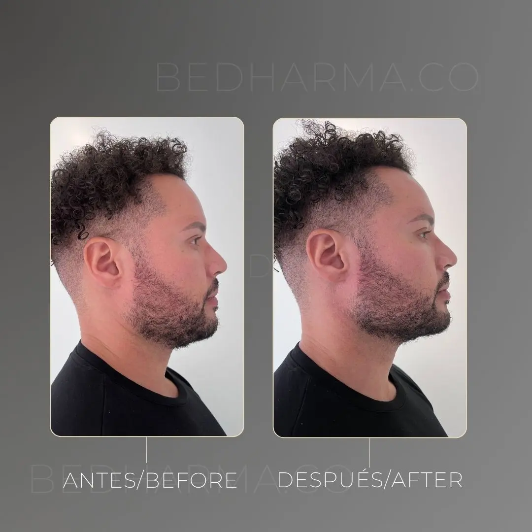 Masculinización facial antes y después en la clínica estética Be Dharma de Medellín - 070426 2