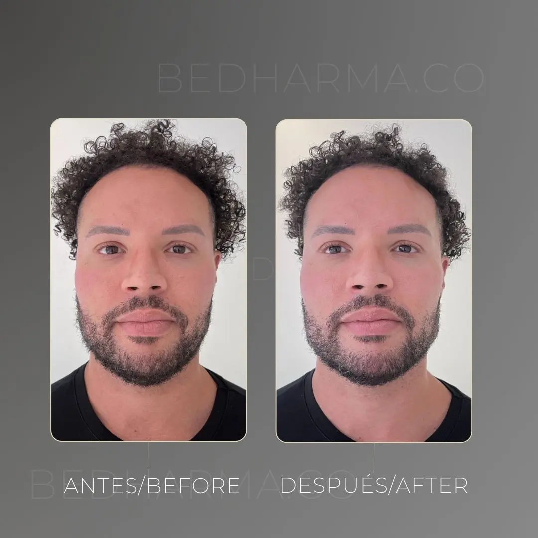 Masculinización facial antes y después en la clínica estética Be Dharma de Medellín - 070426