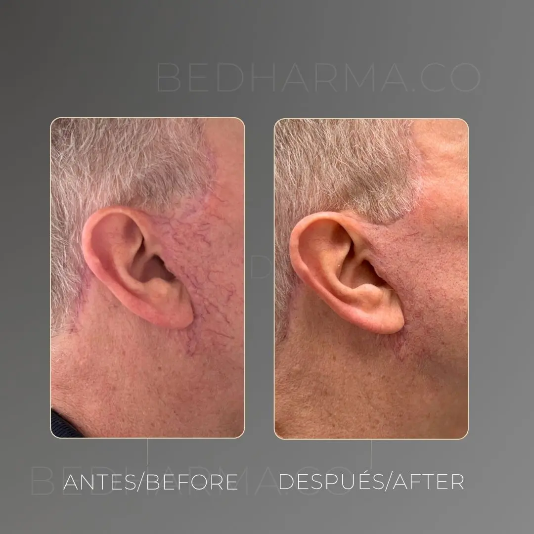 Escleroterapia láser antes y después - Clínica estética Be Dharma de Medellín - 220425