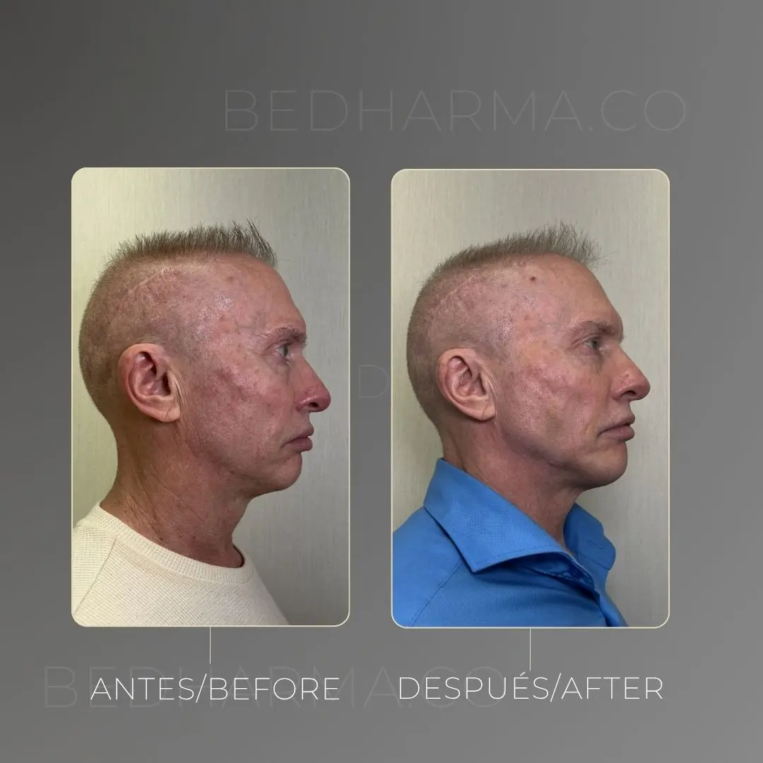 Full face con bioestimuladores antes y después - Clínica estética Be Dharma de Medellín - 080425 2