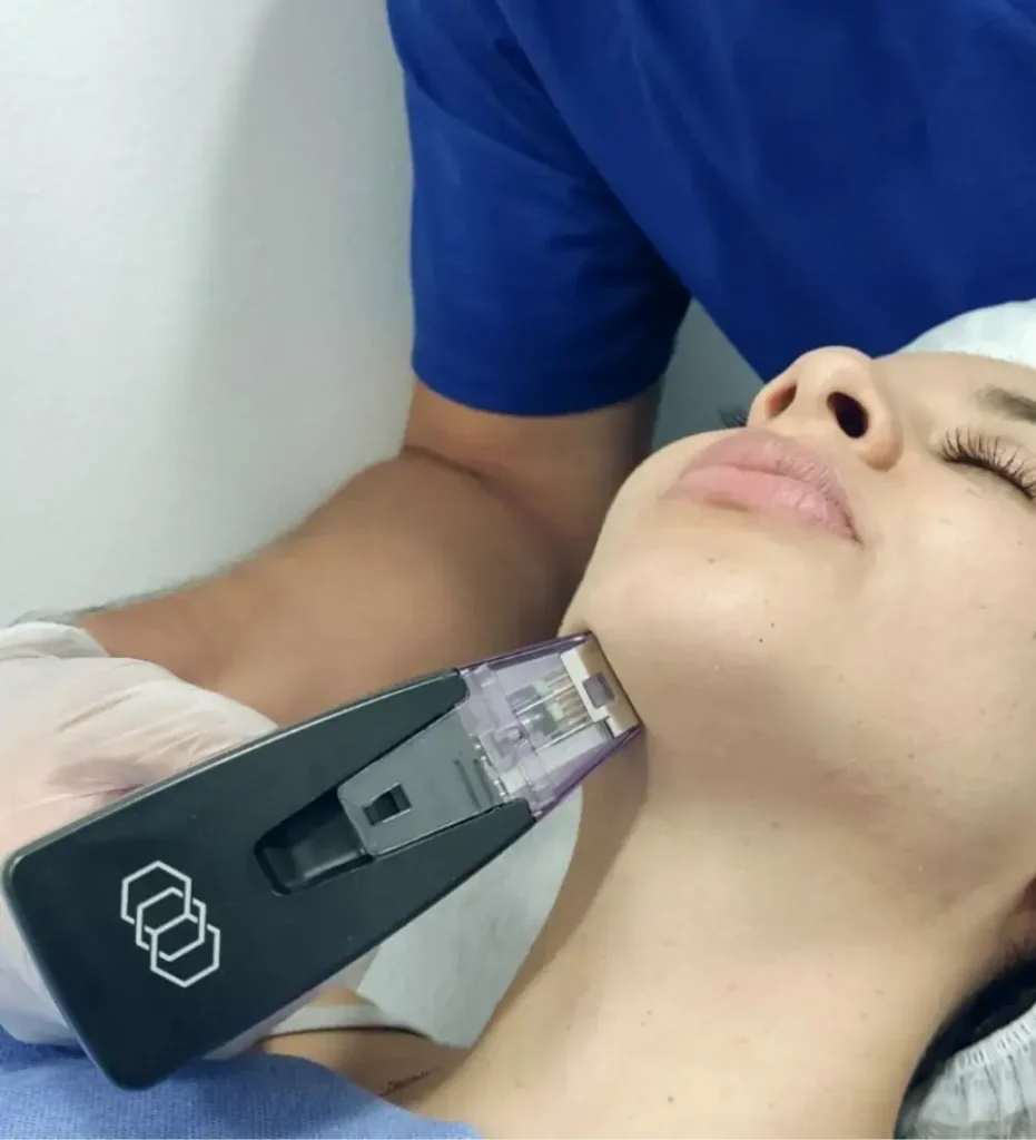 Tratamiento para cicatrices en Medellín- Clínica Be Dharmal- Morpheus en cara