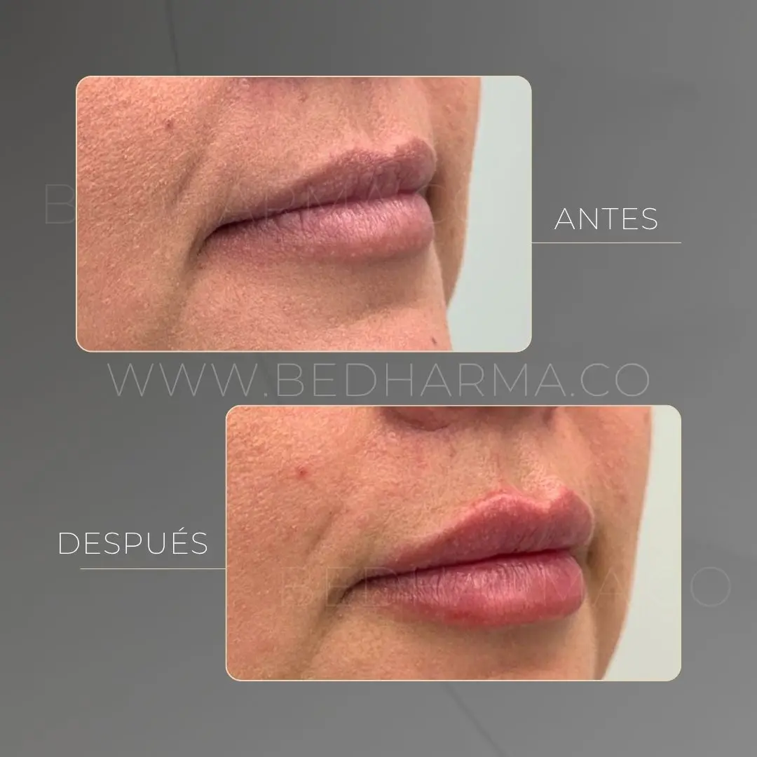 Aumento de labios con ácido hialurónico antes y después en la clínica estética Be Dharma - 050626 2