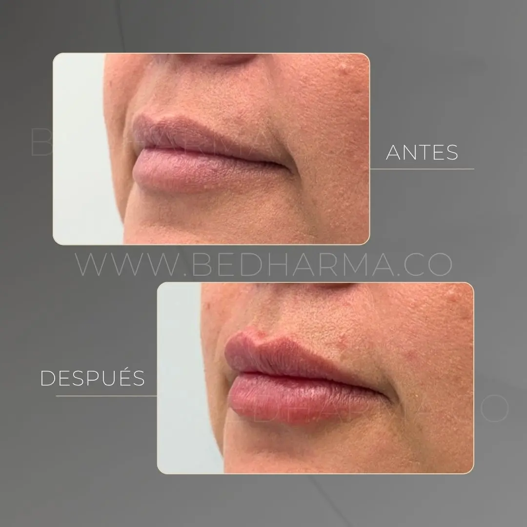 Aumento de labios con ácido hialurónico antes y después en la clínica estética Be Dharma - 050626 3