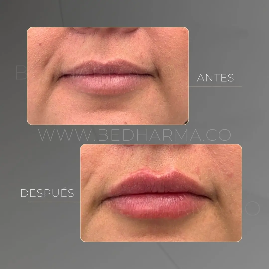 Aumento de labios con ácido hialurónico antes y después en la clínica estética Be Dharma - 050626