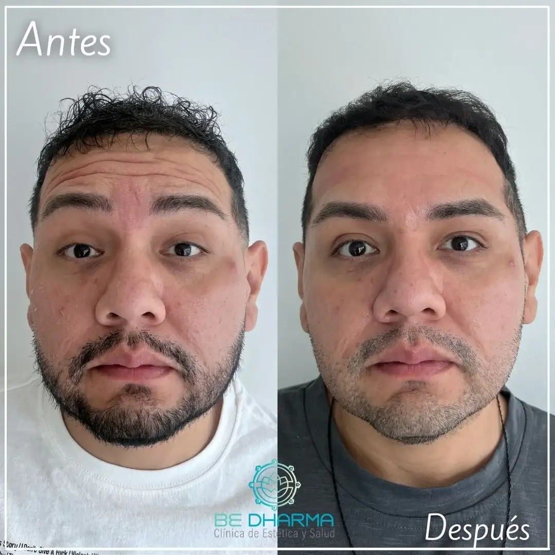 Botox in Medellín-Clínica Be Dharma Medellín- Before and after