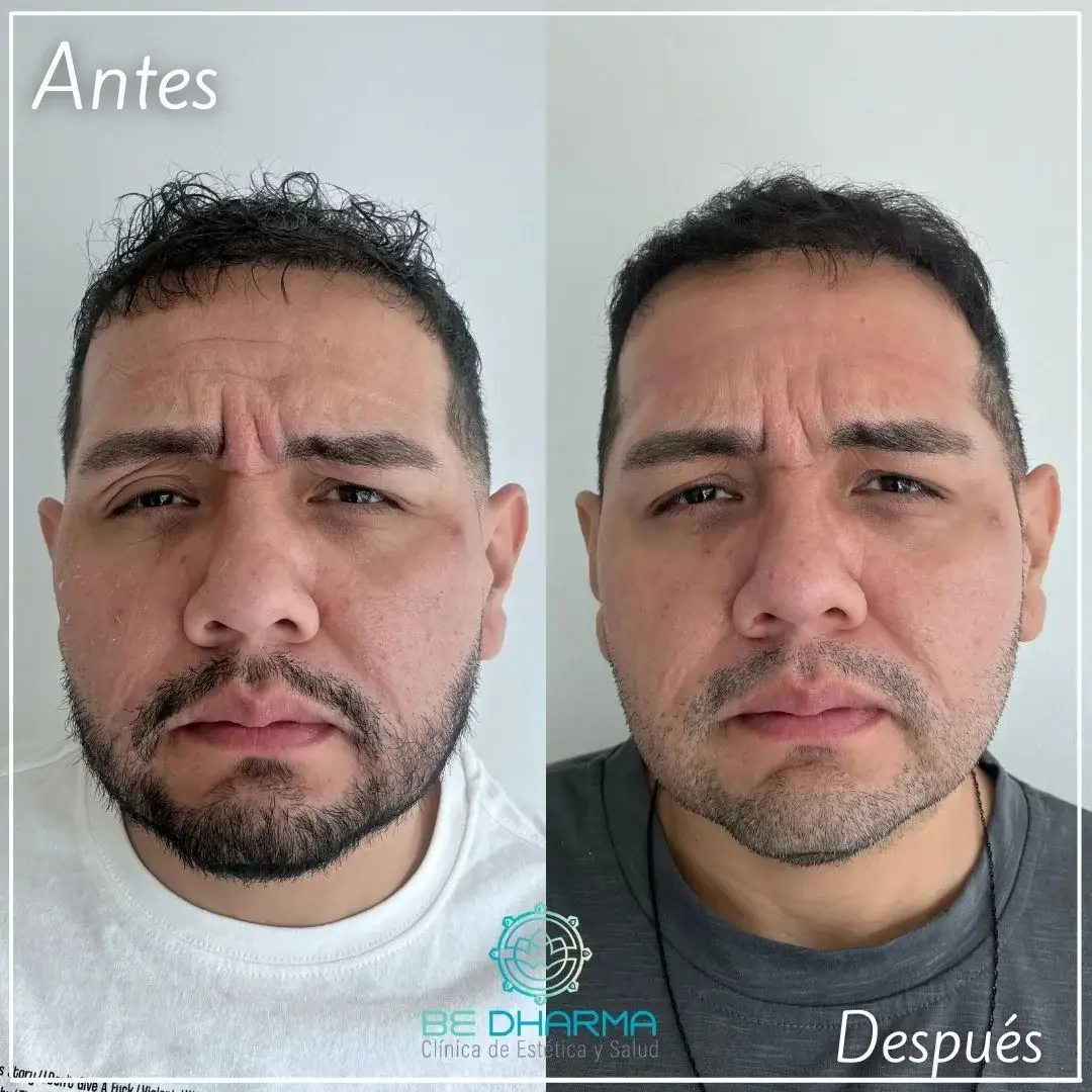 Botox in Medellín-Clínica Be Dharma Medellín- Before and after