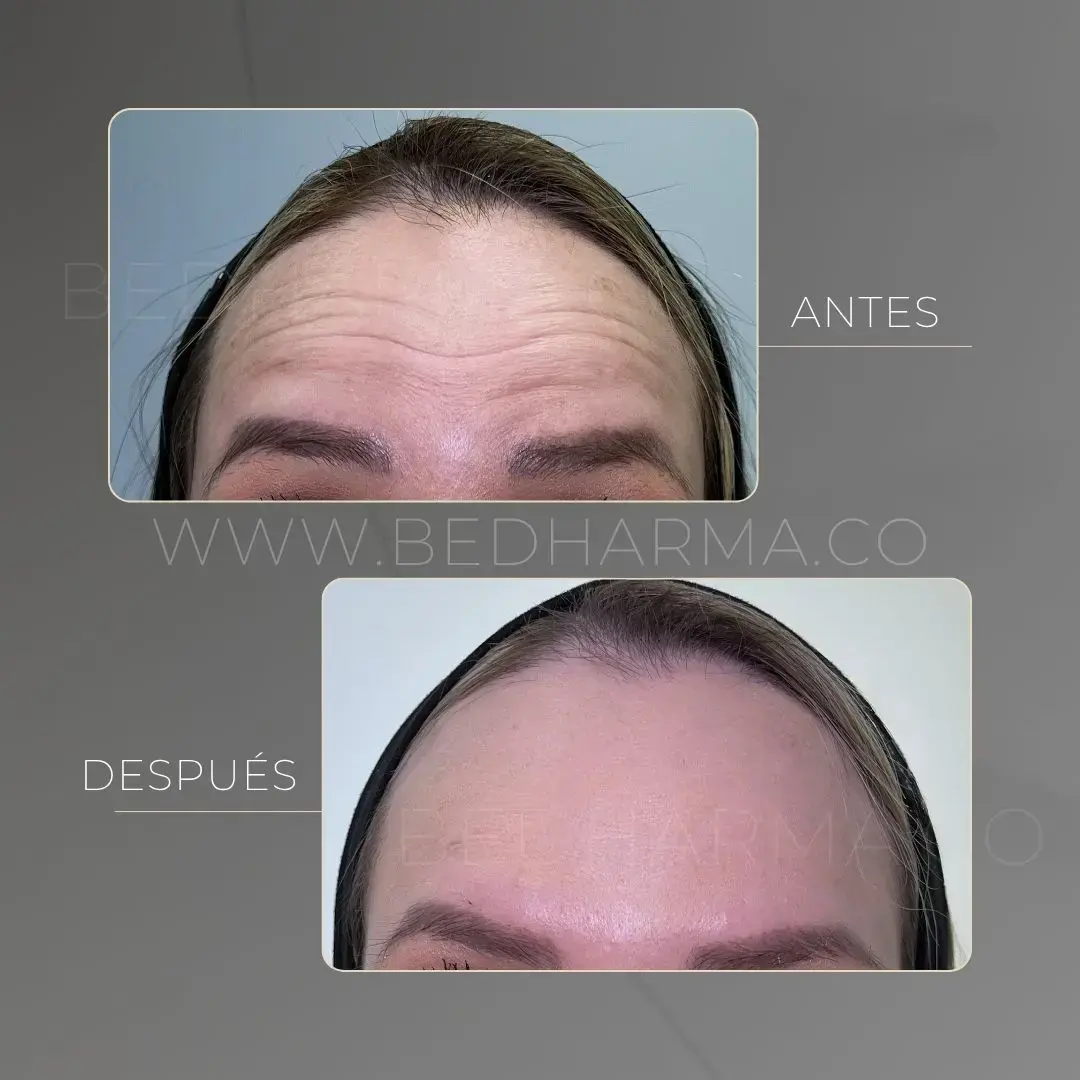Botox in Medellín-Clínica Be Dharma Medellín- Before and after