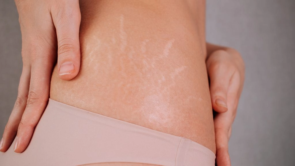 Láser fotona - estrias y rosacea - be dharma