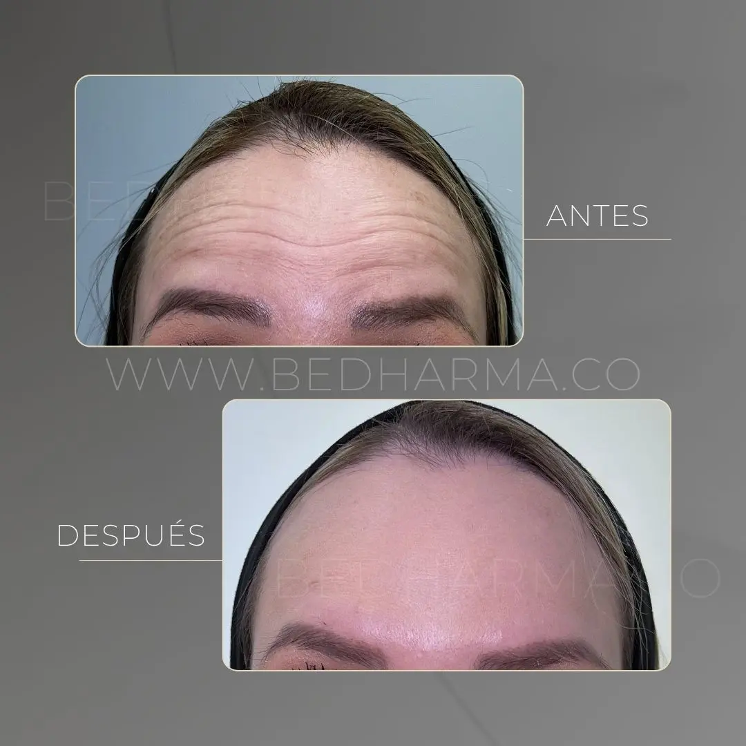 Toxina botulínica en la frente antes y después en la clínica estética Be Dharma - 050626