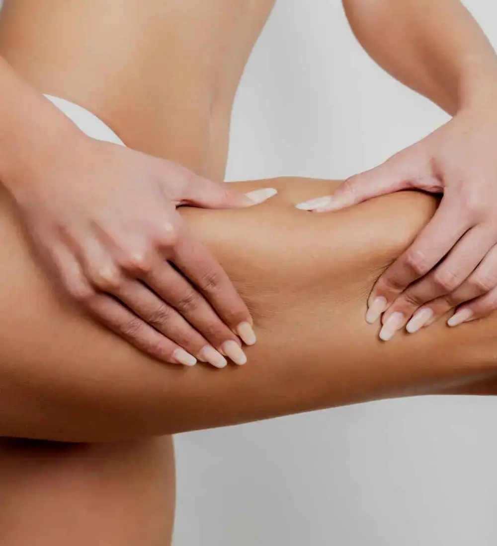 Tratamiento para la celulitis-Clínica Be Dharma- Mesoterapia