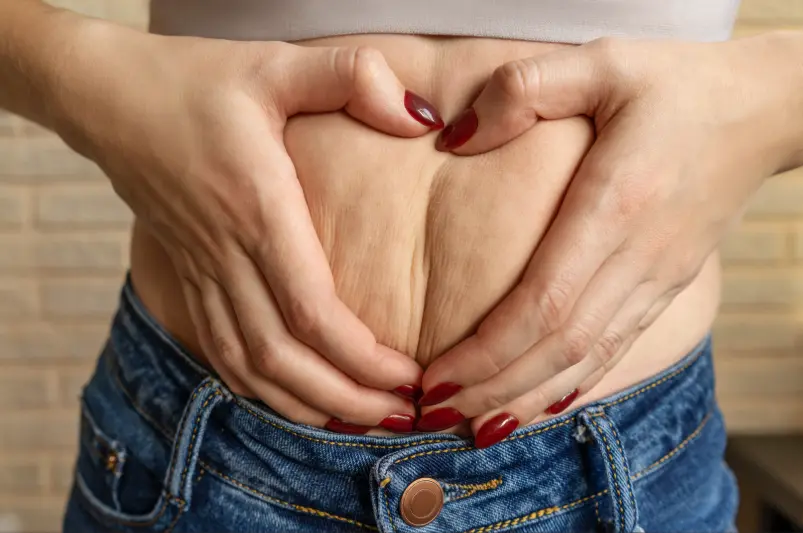 Tratamiento para la celulitis en barriga-Clínica Be Dharma