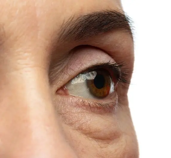 Aplicación de esperma de salmón en ojeras - Clínica BeDharma - Medellín, Colombia