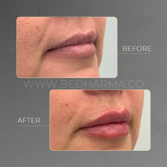 Lip augmentation fillers- Clínica Be Dharma before and after