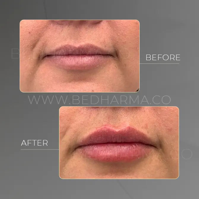 Lip augmentation fillers- Clínica Be Dharma before and after