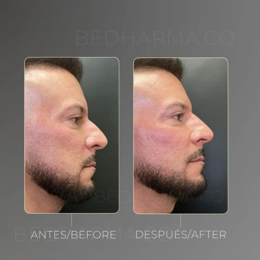 Non-Surgical Nose Job in Medellín- Clínica Be Dharma Medellín before and after