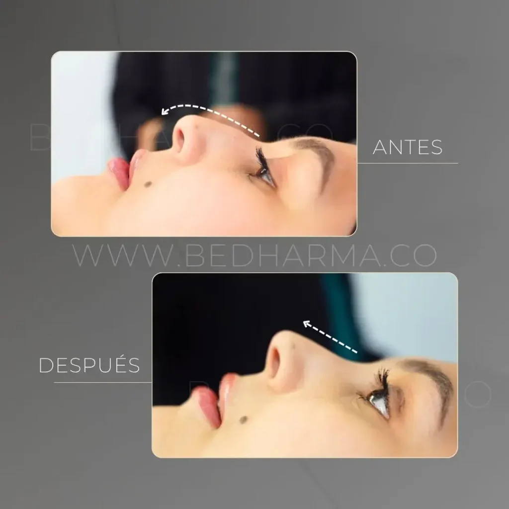 Non-Surgical Nose Job in Medellín- Clínica Be Dharma Medellín before and after