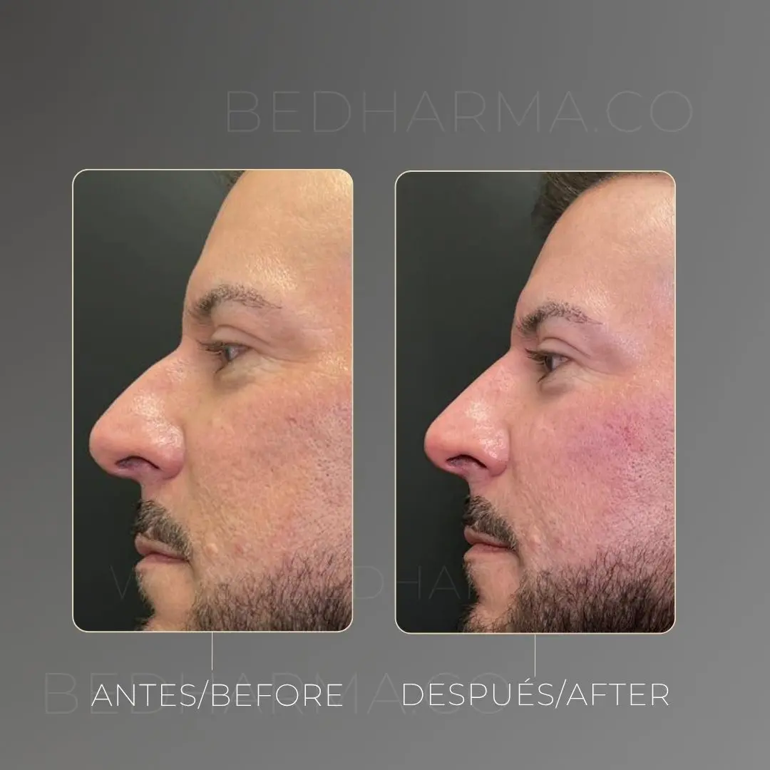 Rinomodelación antes y después en la clínica estética Be Dharma - 060726 1