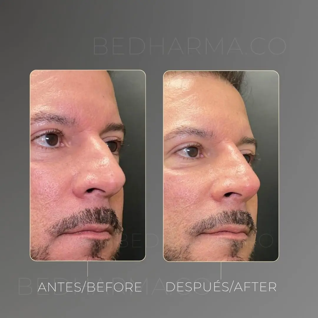 Rinomodelación antes y después en la clínica estética Be Dharma - 060726 2