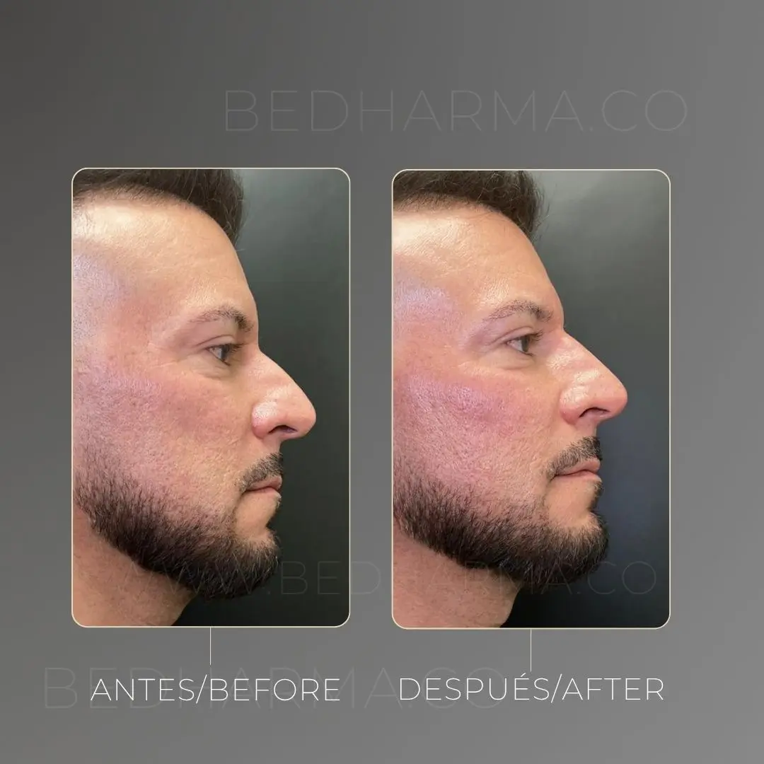 Rinomodelación antes y después en la clínica estética Be Dharma - 060726