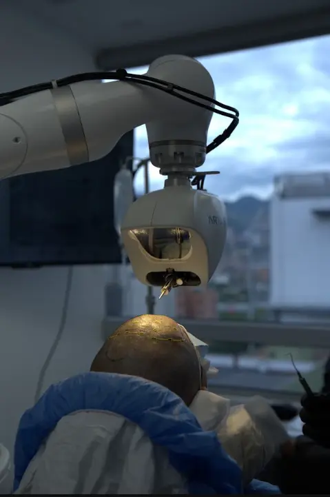 Hair Transplant in Medellin- Clínica Be Dharma in Medellín, Colombia