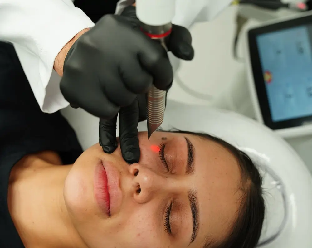 Laser fotona para ojeras - Clínica Be Dharma - Medellín, Colombia