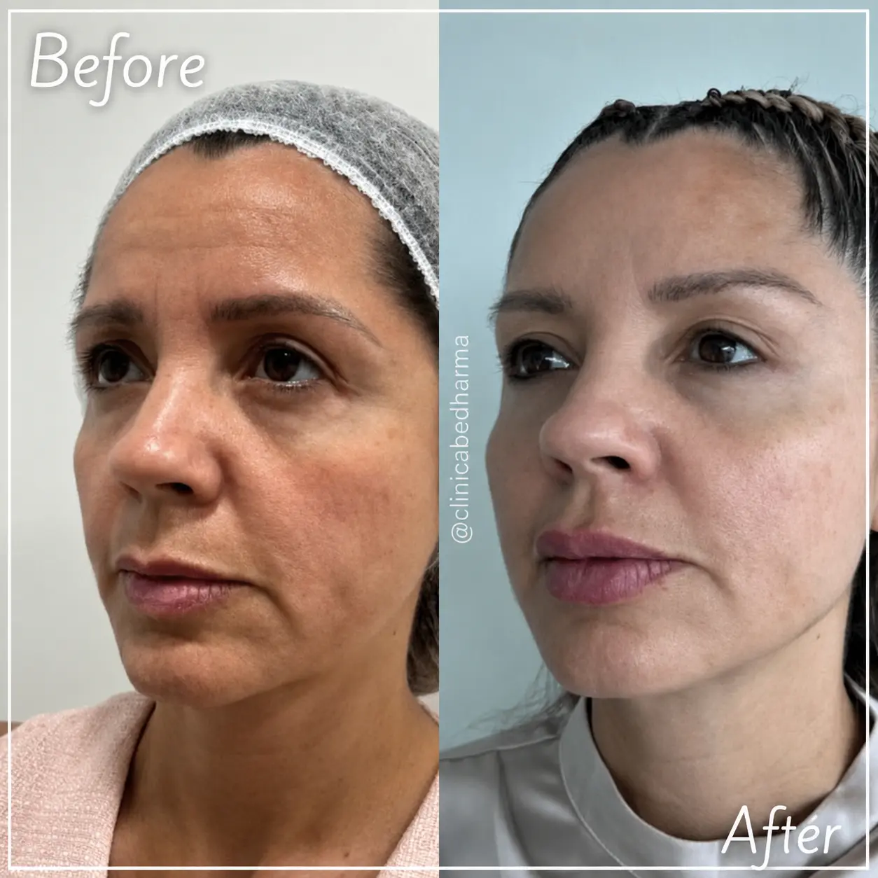 Radiesse Before and After - Clínica BeDharma - Medellín, Colombia