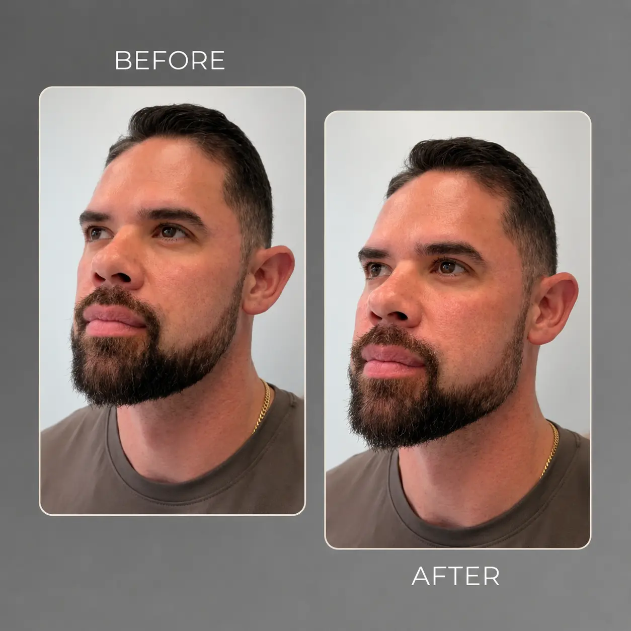 Radiesse treatment - Clínica BeDharma - Medellín, Colombia