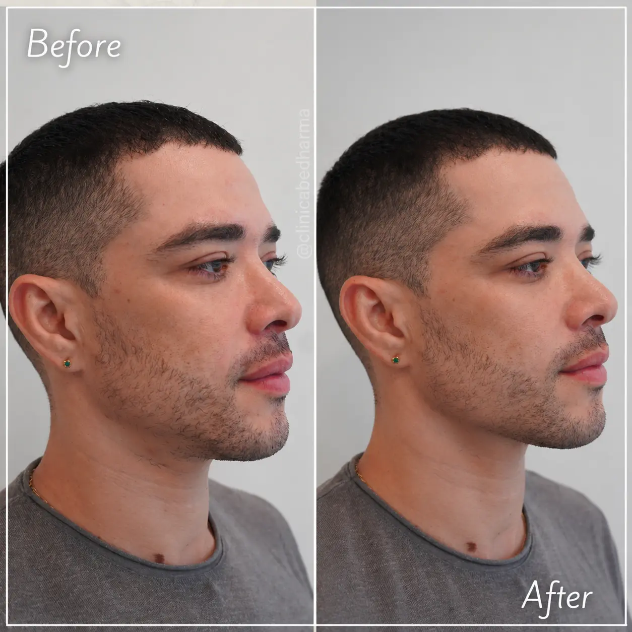 Radiesse treatment before and after - Clínica Be Dharma - Medellín, Colombia