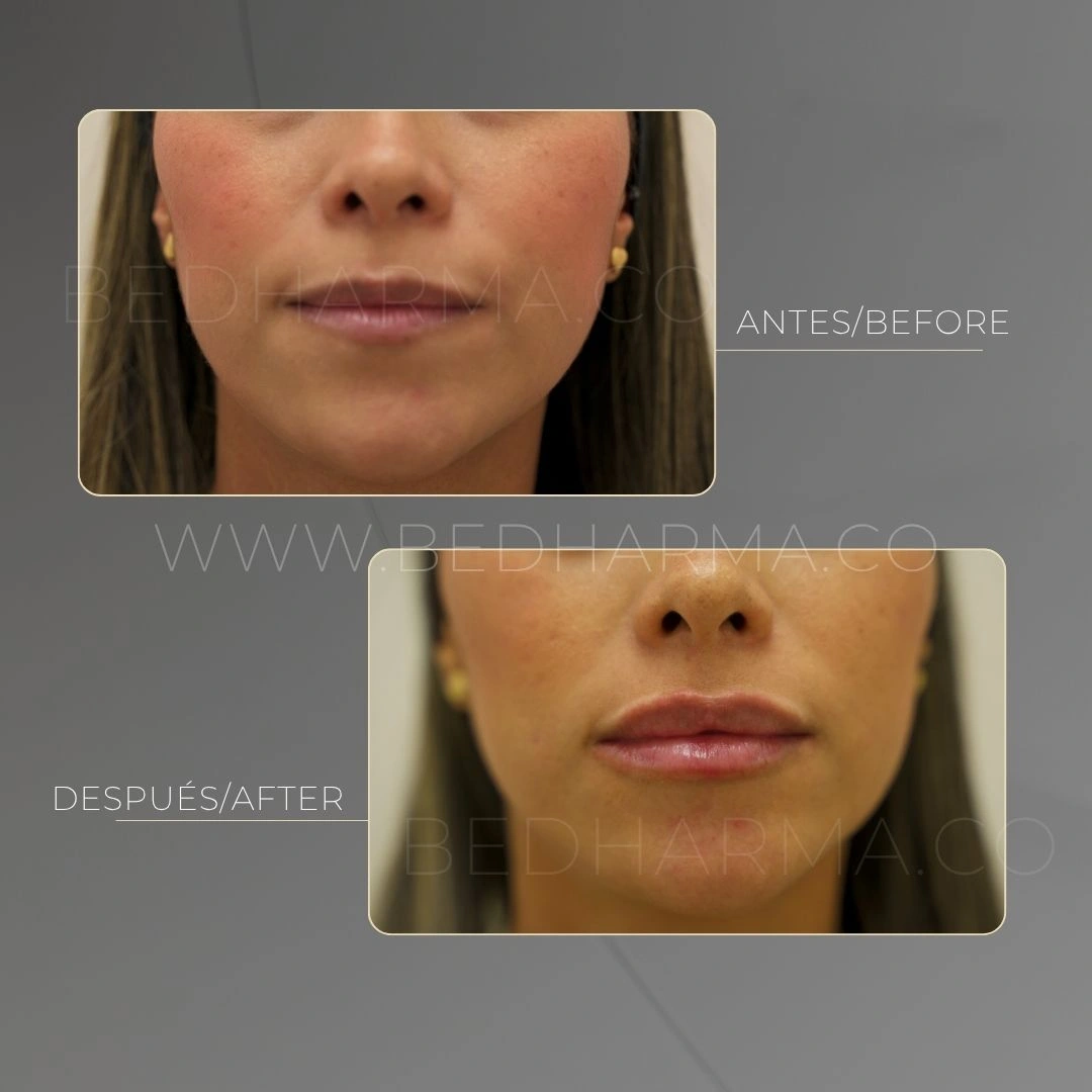 Armonización de labios con Ácido Hialurónico en Medellín - Clínica Estética Be Dharma