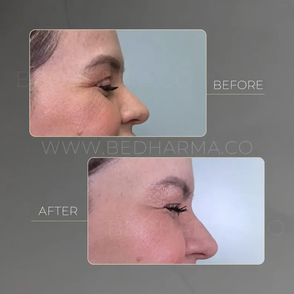 Botulinum Toxin Treatment Medellín- Clínica Be Dharma
