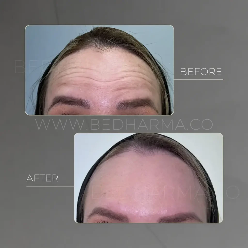 Botulinum Toxin Treatment Medellín, Colombia- Clínica Be Dharma