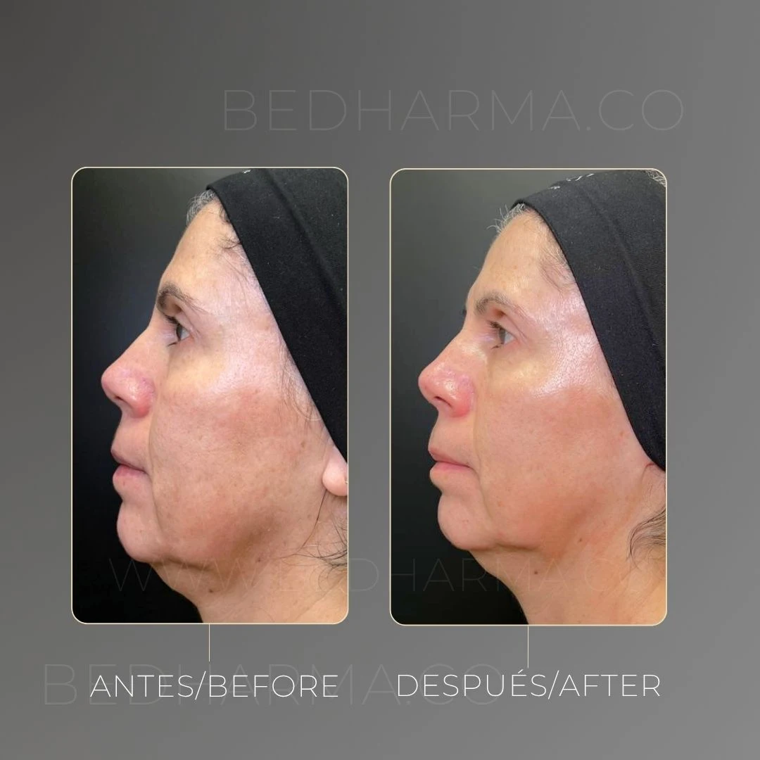Despigmentación de manchas en la piel con Láser Colormax - Clínica Estética en Medellín Be Dharma en Torre Médica Oviedo