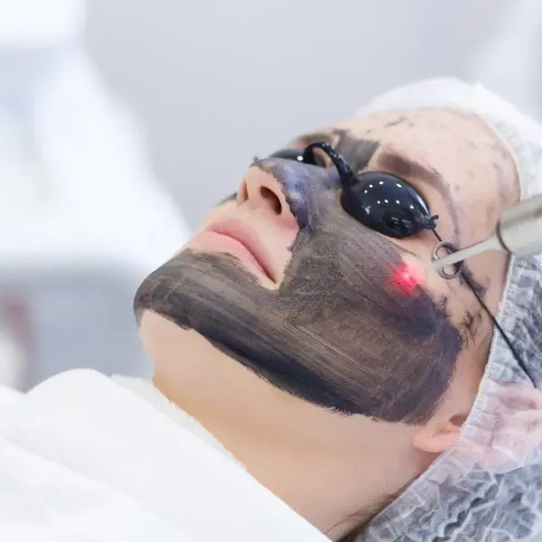 Hollywood Peel carbon laser facial treatment at Clínica Be Dharma in Medellín
