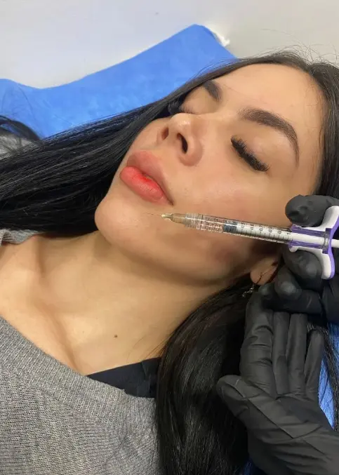Lip Fillers in Medellín- Clínica Be Dharma