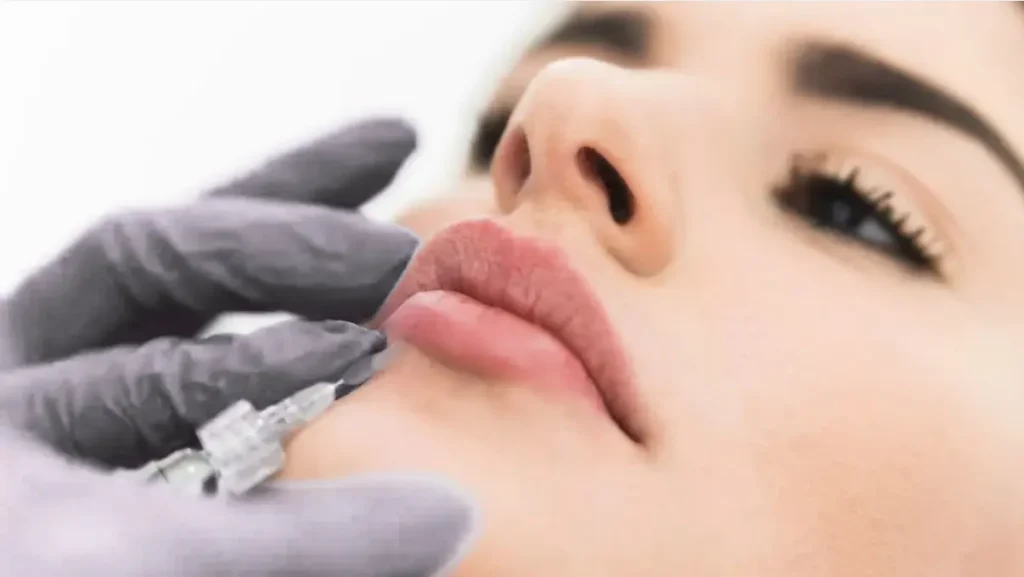 Lip Fillers in Medellín, Colombia- Clínica Be Dharma